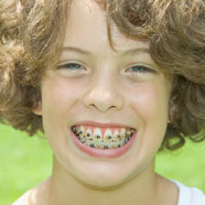 stock photo of a girl with braces